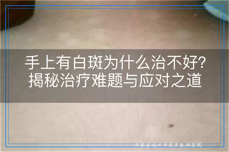 手上有白斑为什么治不好？揭秘治疗难题与应对之道