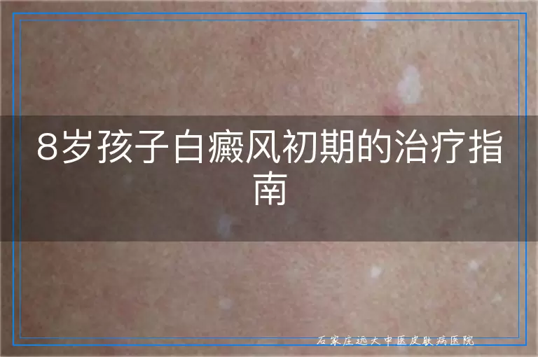 8岁孩子白癜风初期的治疗指南