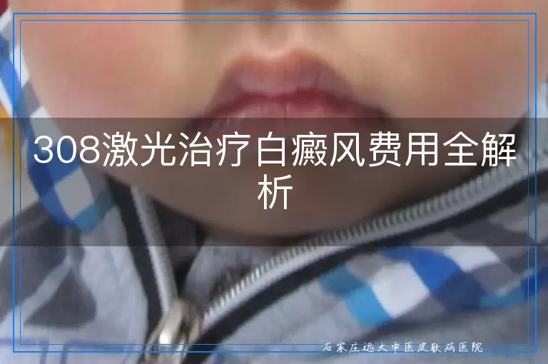 308激光治疗白癜风费用全解析