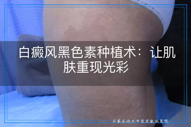 白癜风黑色素种植术：让肌肤重现光彩