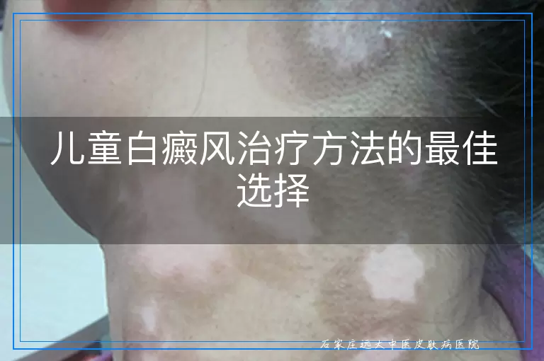 儿童白癜风治疗方法的最佳选择