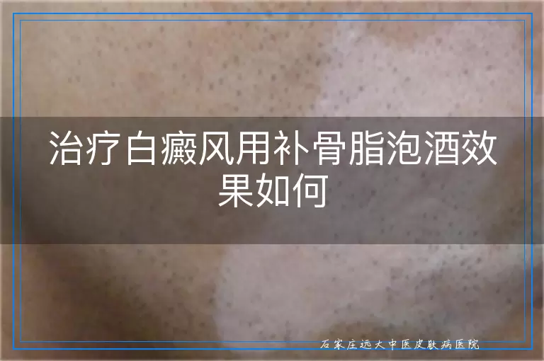 治疗白癜风用补骨脂泡酒效果如何