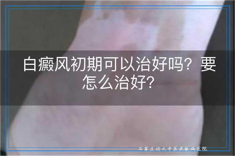 白癜风初期可以治好吗？要怎么治好？