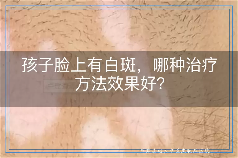 孩子脸上有白斑，哪种治疗方法效果好？