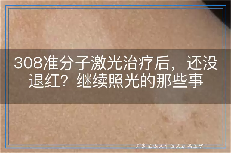 308准分子激光治疗后，还没退红？继续照光的那些事