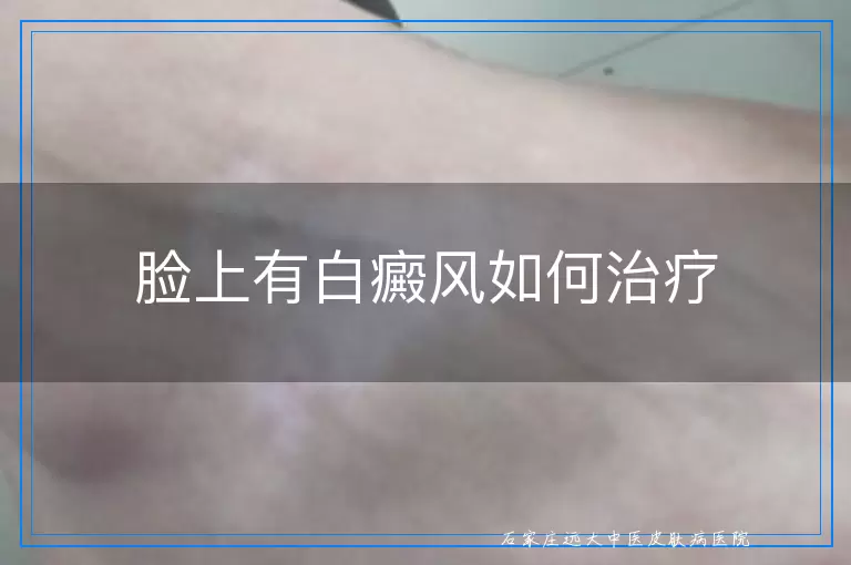 脸上有白癜风如何治疗