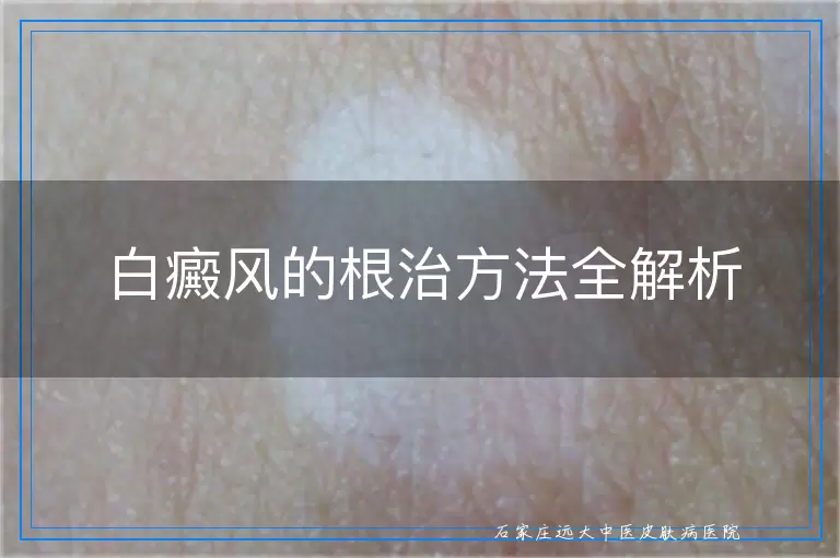 白癜风的根治方法全解析