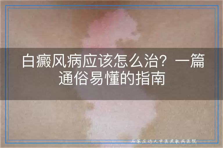 白癜风病应该怎么治？一篇通俗易懂的指南