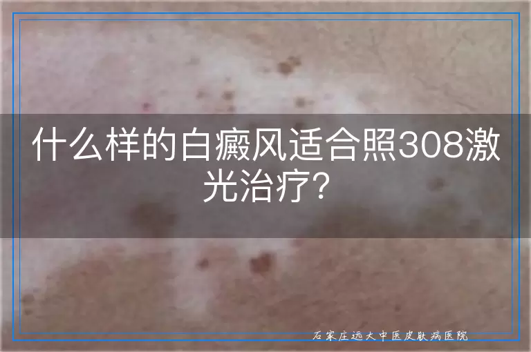 什么样的白癜风适合照308激光治疗？