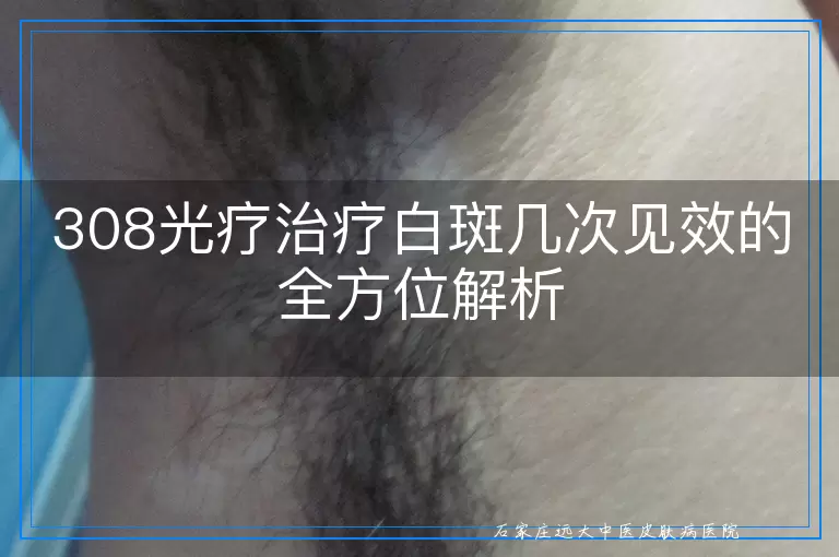 308光疗治疗白斑几次见效的全方位解析