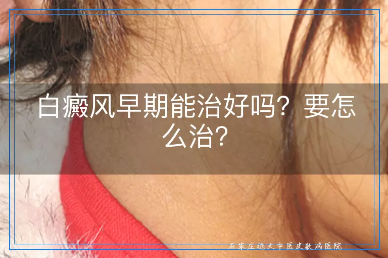 白癜风早期能治好吗？要怎么治？