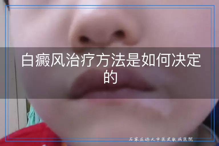 白癜风治疗方法是如何决定的