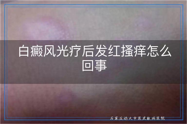白癜风光疗后发红搔痒怎么回事