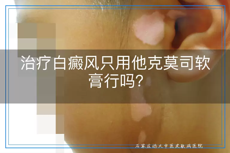 治疗白癜风只用他克莫司软膏行吗？