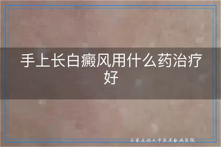 手上长白癜风用什么药治疗好