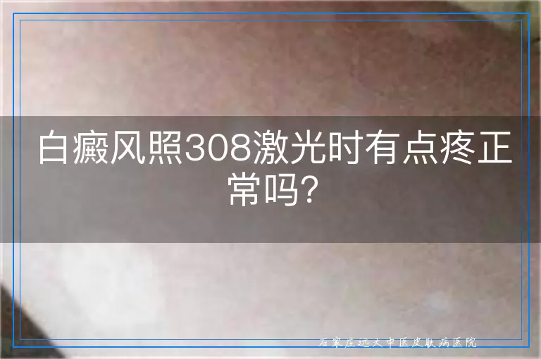 白癜风照308激光时有点疼正常吗？