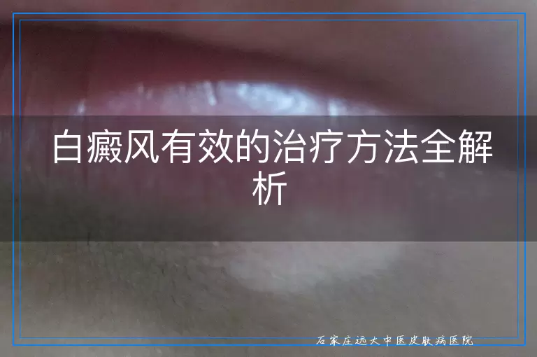 白癜风有效的治疗方法全解析