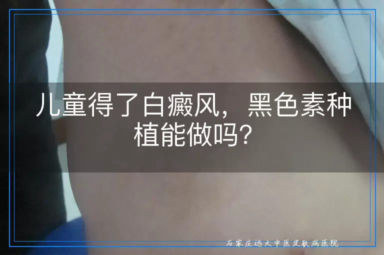 儿童得了白癜风，黑色素种植能做吗？
