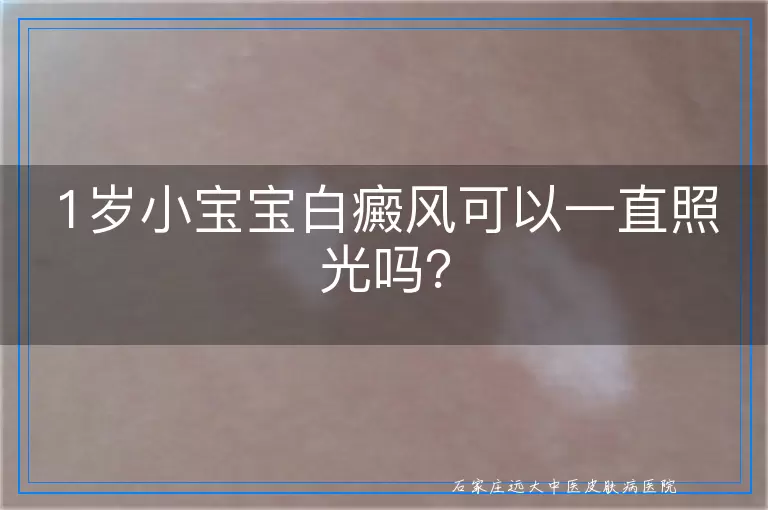 1岁小宝宝白癜风可以一直照光吗？