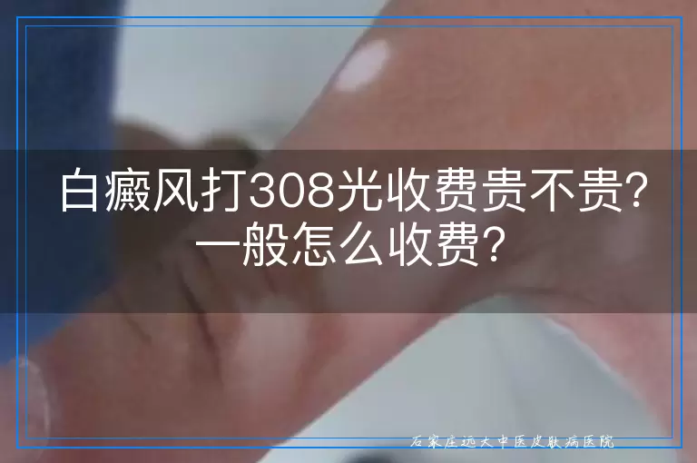 白癜风打308光收费贵不贵？一般怎么收费？