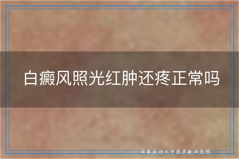 白癜风照光红肿还疼正常吗
