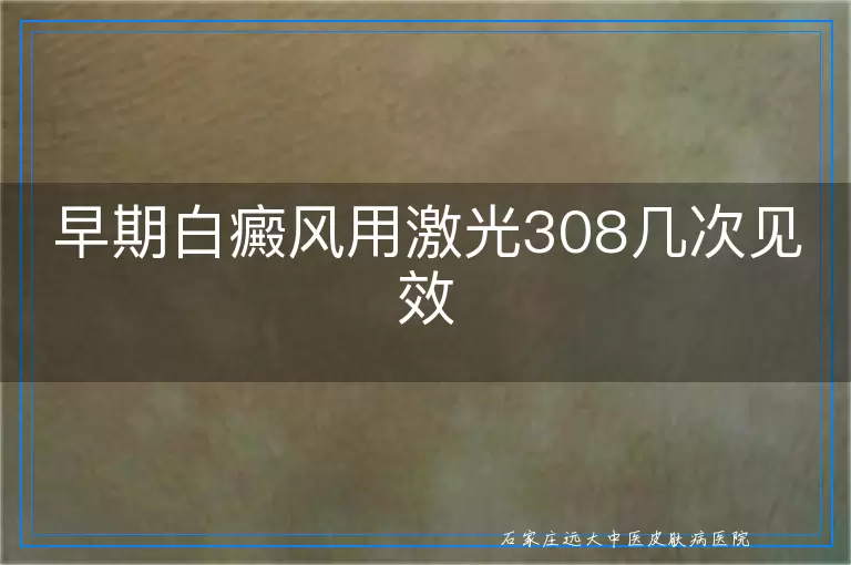 早期白癜风用激光308几次见效