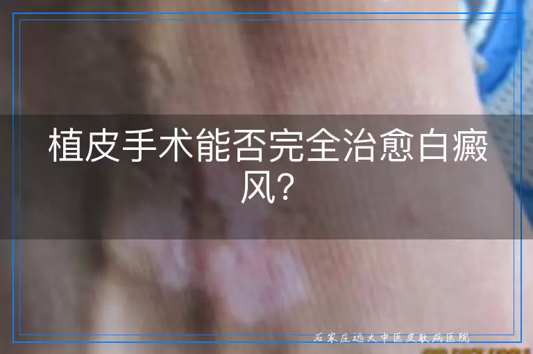 植皮手术能否完全治愈白癜风？