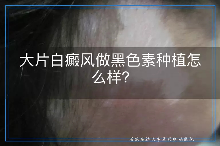 大片白癜风做黑色素种植怎么样？