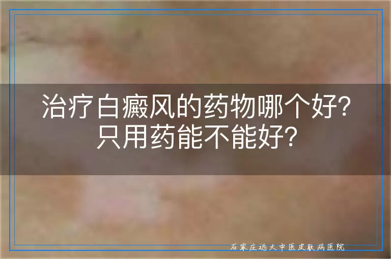 治疗白癜风的药物哪个好？只用药能不能好？