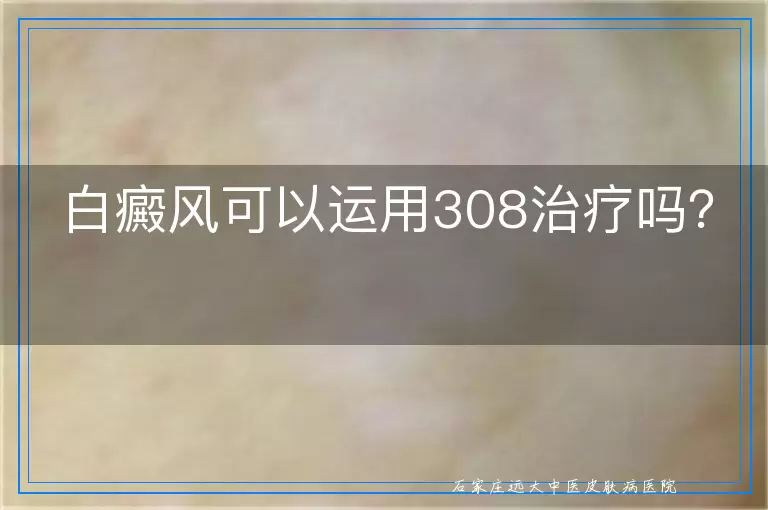 白癜风可以运用308治疗吗？