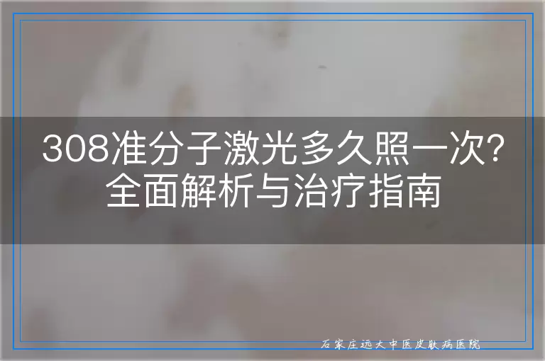 308准分子激光多久照一次？全面解析与治疗指南