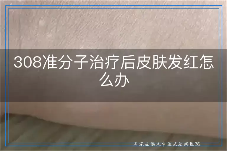 308准分子治疗后皮肤发红怎么办