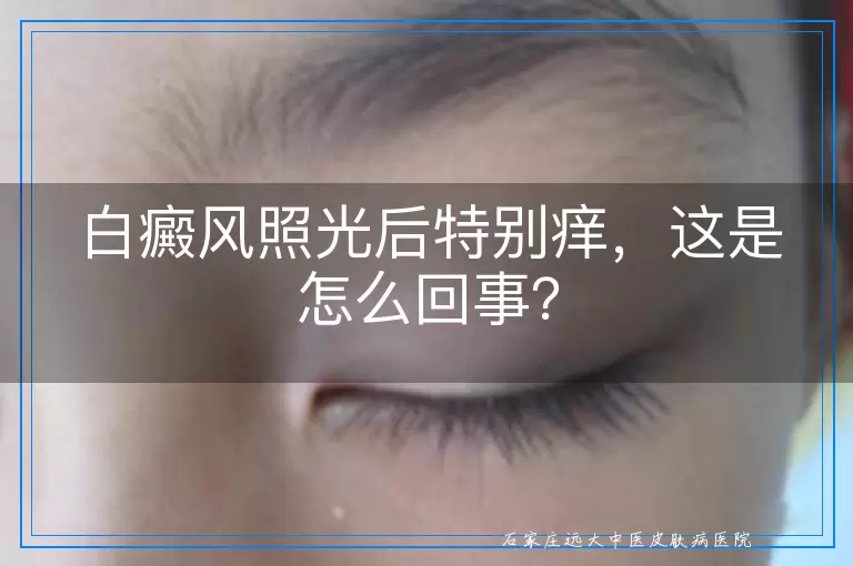 白癜风照光后特别痒，这是怎么回事？