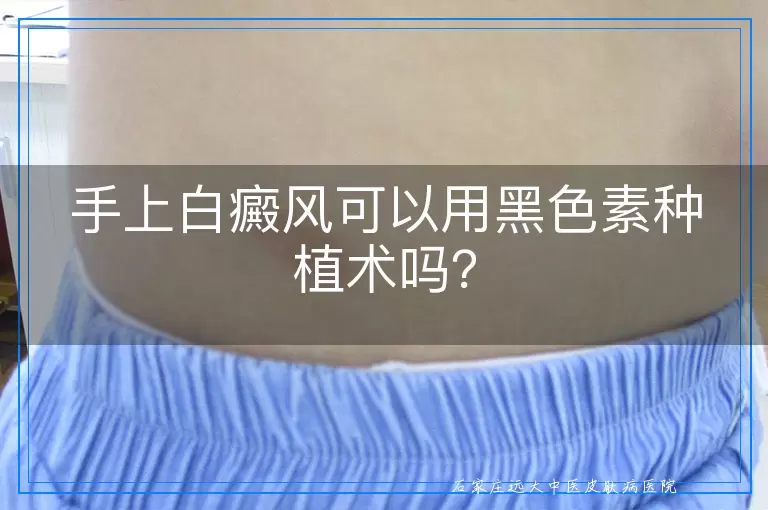 手上白癜风可以用黑色素种植术吗？