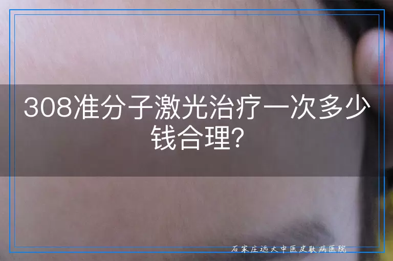 308准分子激光治疗一次多少钱合理？