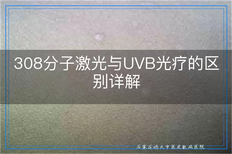 308分子激光与UVB光疗的区别详解