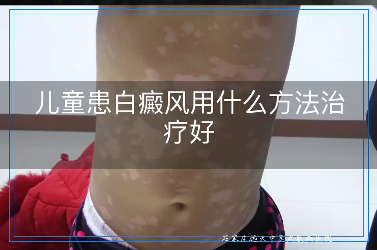儿童患白癜风用什么方法治疗好