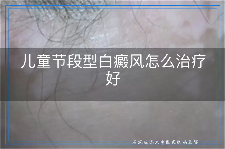 儿童节段型白癜风怎么治疗好