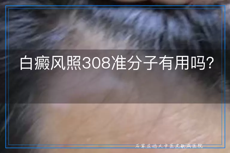 白癜风照308准分子有用吗？