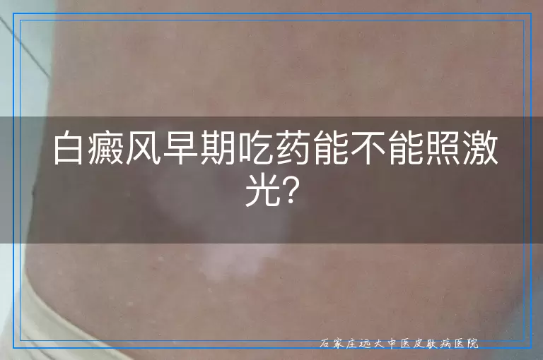 白癜风早期吃药能不能照激光？