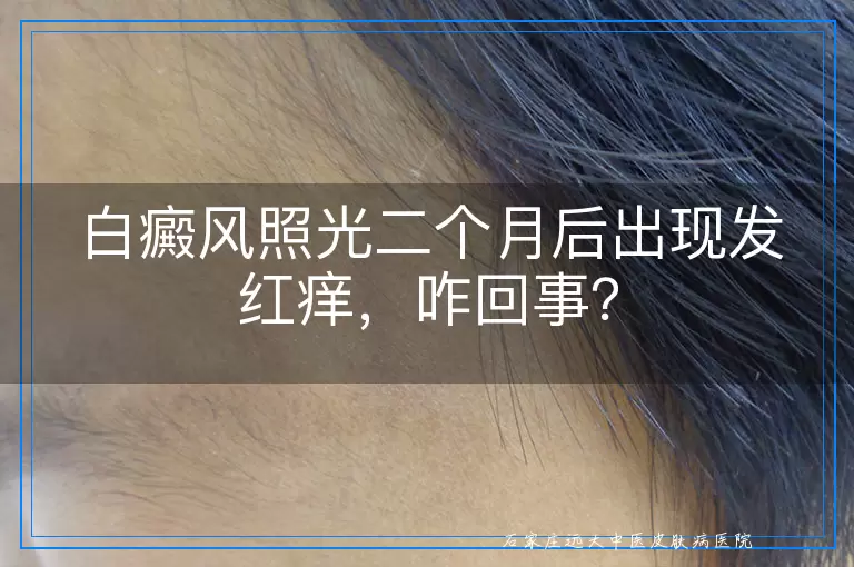 白癜风照光二个月后出现发红痒，咋回事？