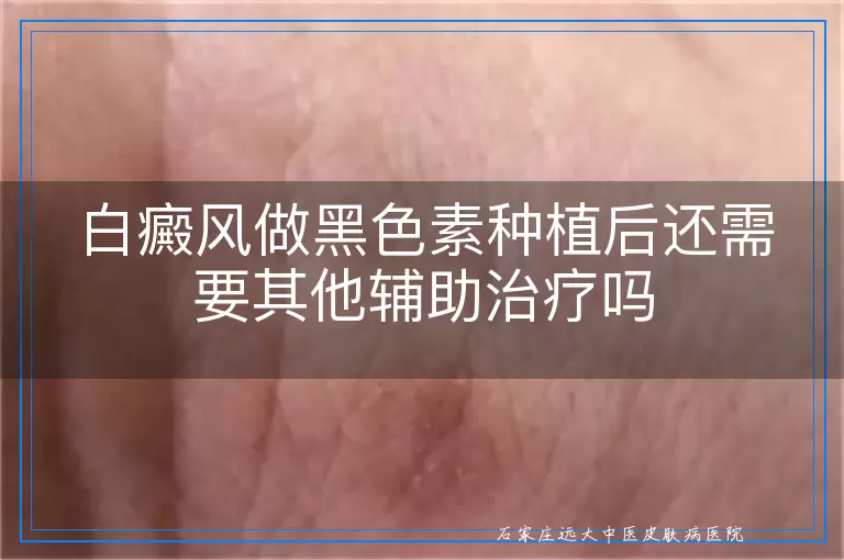 白癜风做黑色素种植后还需要其他辅助治疗吗