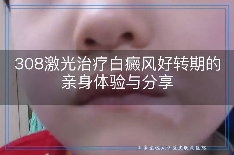 308激光治疗白癜风好转期的亲身体验与分享