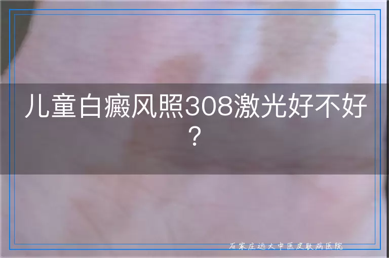 儿童白癜风照308激光好不好？