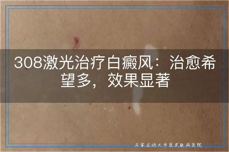 308激光治疗白癜风：治愈希望多，效果显著