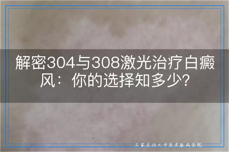 解密304与308激光治疗白癜风：你的选择知多少？
