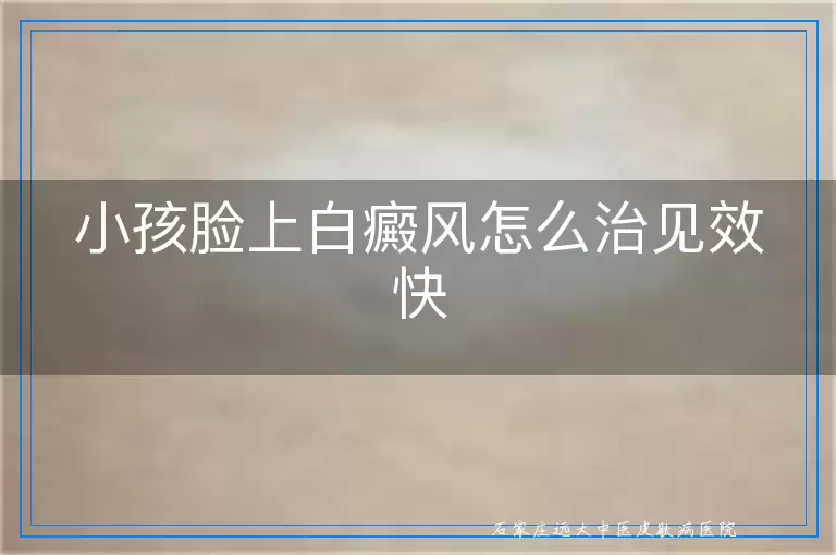 小孩脸上白癜风怎么治见效快