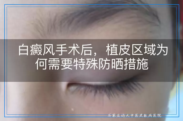 白癜风手术后，植皮区域为何需要特殊防晒措施