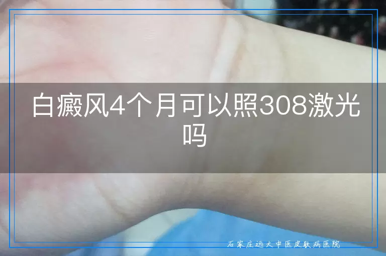 白癜风4个月可以照308激光吗