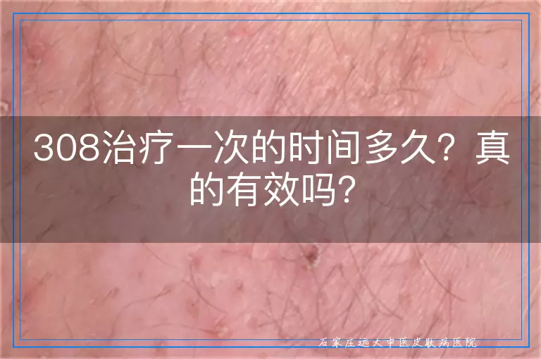 308治疗一次的时间多久？真的有效吗？